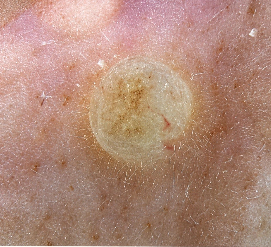 The same area of skin under visible light